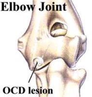 Osteochondritis Dissecans Elbow Treatment Bangalore 