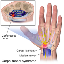 Carpal Tunnel Syndrome Treatment Bangalore,Nerve Injury Surgery India