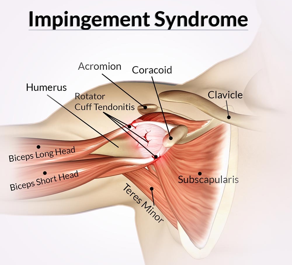 Treatment options for impingement syndrome at Dr. Banarji's Shoulder Center