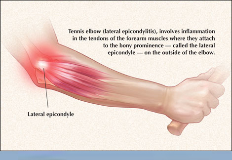 Tennis elbow treatment in Bangalore at Dr. Banarji Shoulder Center