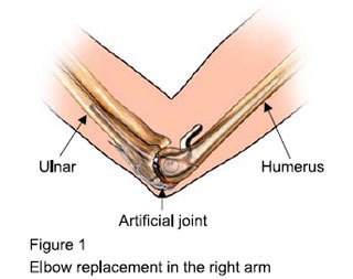 elbow-replacement-surgery-bangalore1818-09-12-10_09_42 - Dr. Banarji Elbow replacement treatment in Bangalore at Dr. Banarji Shoulder Center