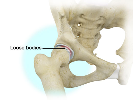 loose-bodies-on - Dr. Banarji Elbow Treatment in Bangalore at Dr. Banarji Shoulder Center