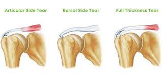 Partial Rotator Cuff Tears treatment in Bangalore at Dr. Banarji Shoulder Center