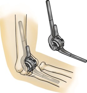 Elbow Arthritis and Replacement Surgery at Dr. Banarji's Shoulder Center