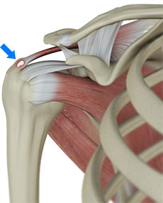 calcific-tendonitis-new - Dr. Banarji Calcific tendinitis treatment in Bangalore at Dr. Banarji Shoulder Center